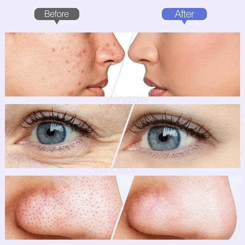 2025 Wireless Diamond Microdermabrasion Machine Blackhead Remover Vacuum Pore Cleaner Facial Skin Care Tool Face Beauty Device - HONORABLE VETERANS SOLUTIONS